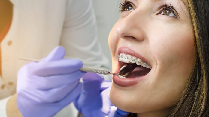 Closeup of beautiful girl on dental braces check up Zahnspangen bei Erwachsenen
